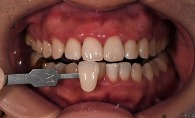 [TU치과/티유치과] 치아변색?? 치아미백으로 해결! 관련 이미지 9