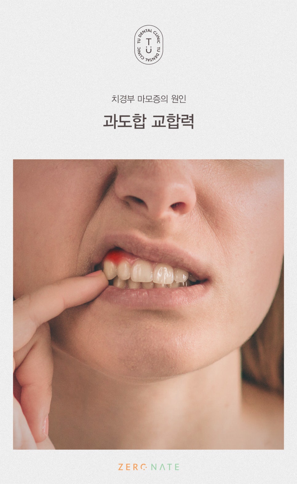 치경부 마모증 치료방법, 티유치과 제로네이트[TU치과] 관련 이미지 5