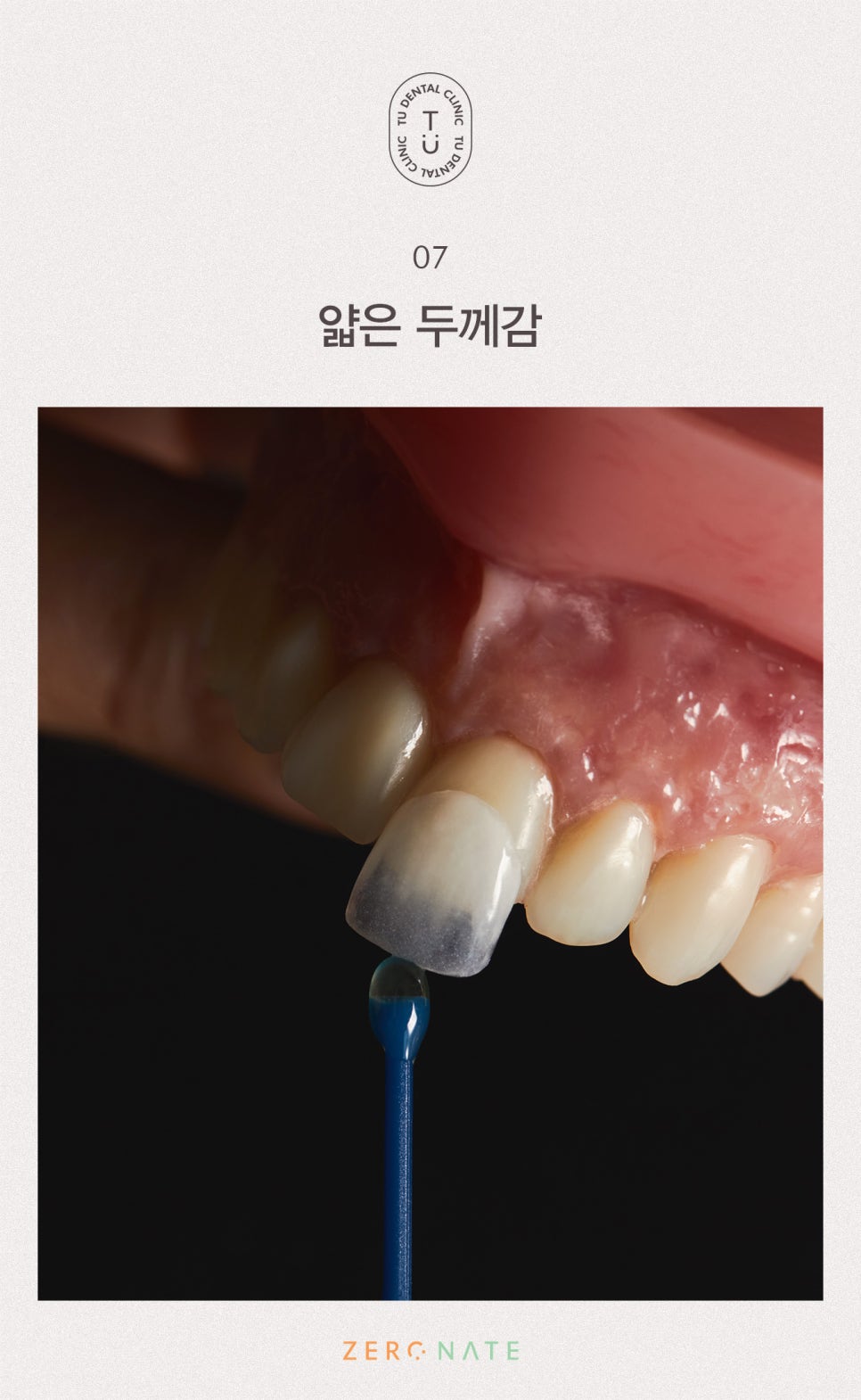티유치과 제로네이트 부작용에 대해 설명드립니다 [TU치과] 관련 이미지 8