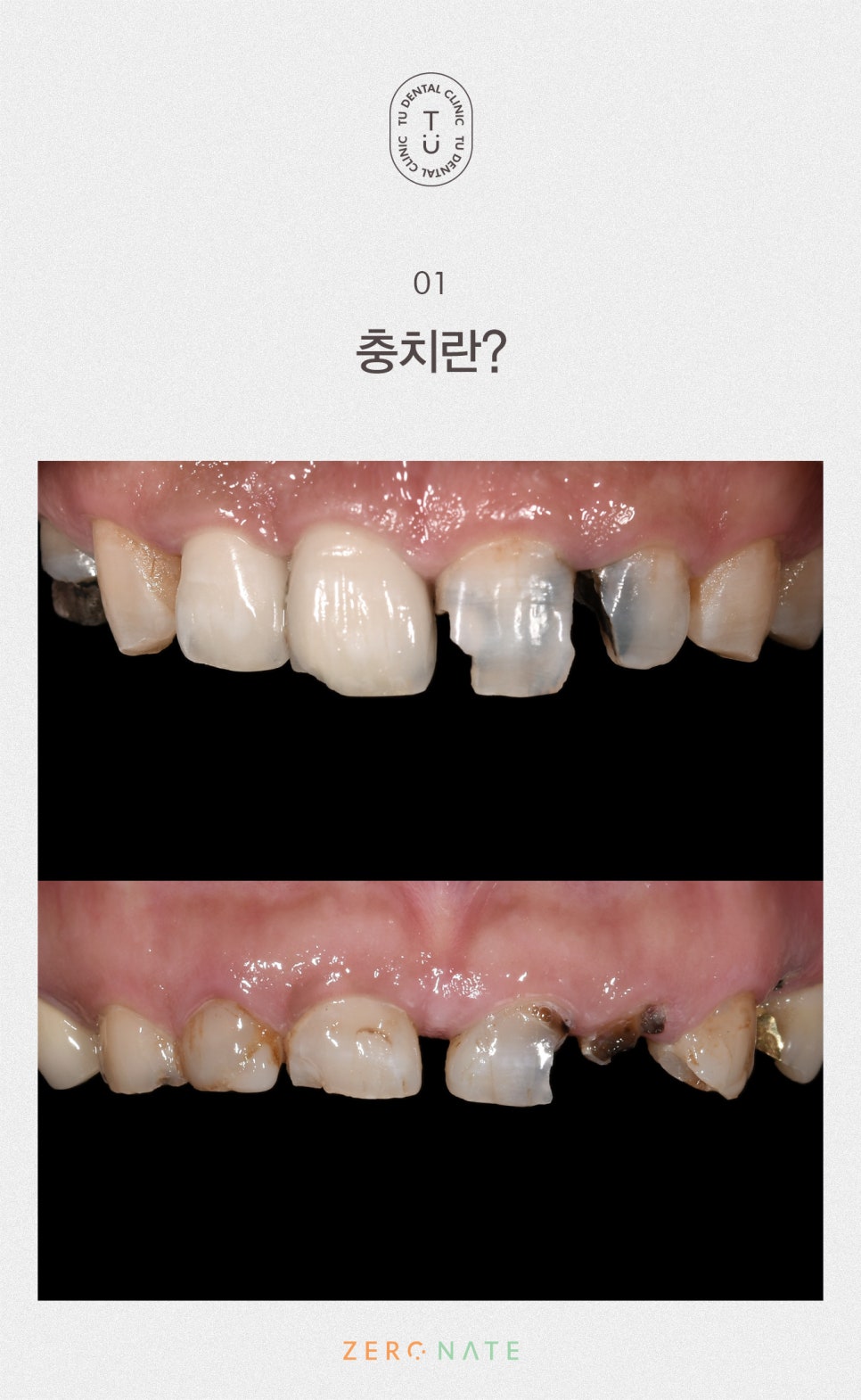 충치의 개선 제로네이트[TU치과] 관련 이미지 2