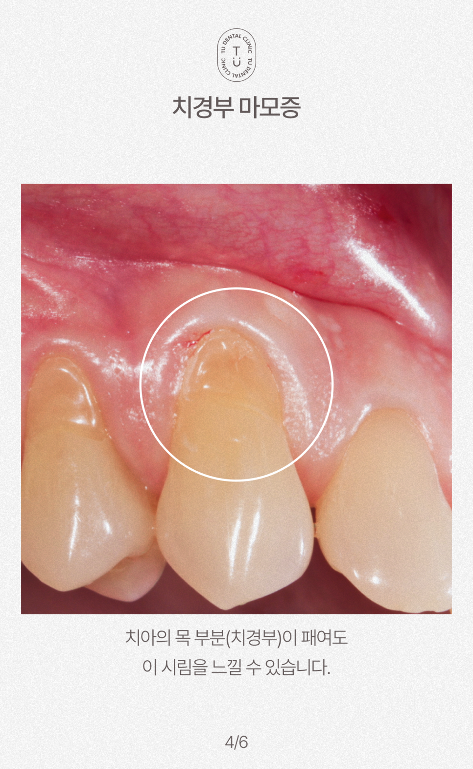 여름철, 이 시린이유가 뭘까요? 티유치과[TU치과] 관련 이미지 5