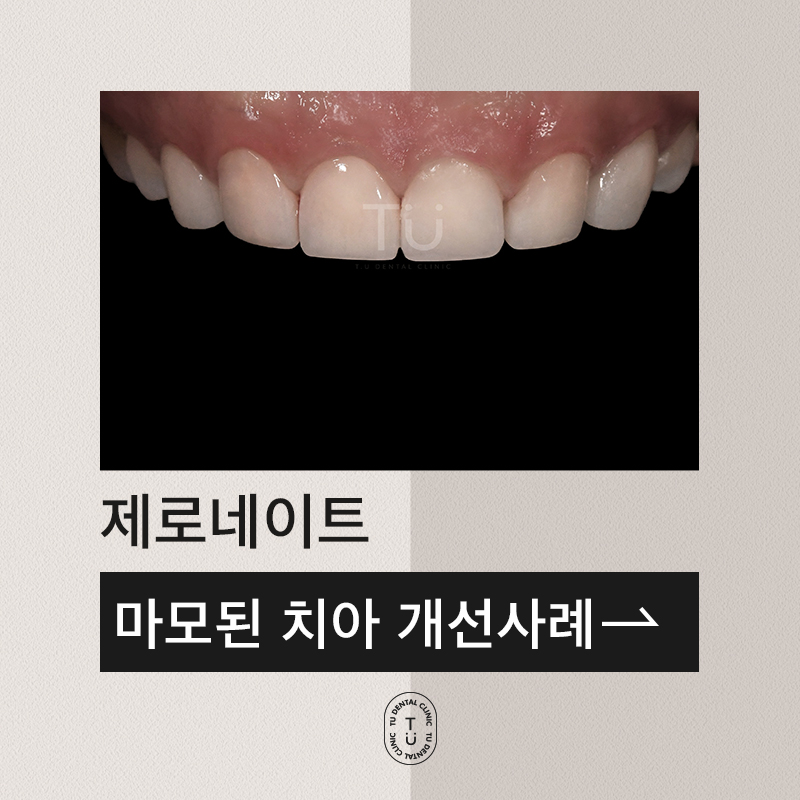 마모된 치아의 개선 사례 : 제로네이트 관련 이미지 1