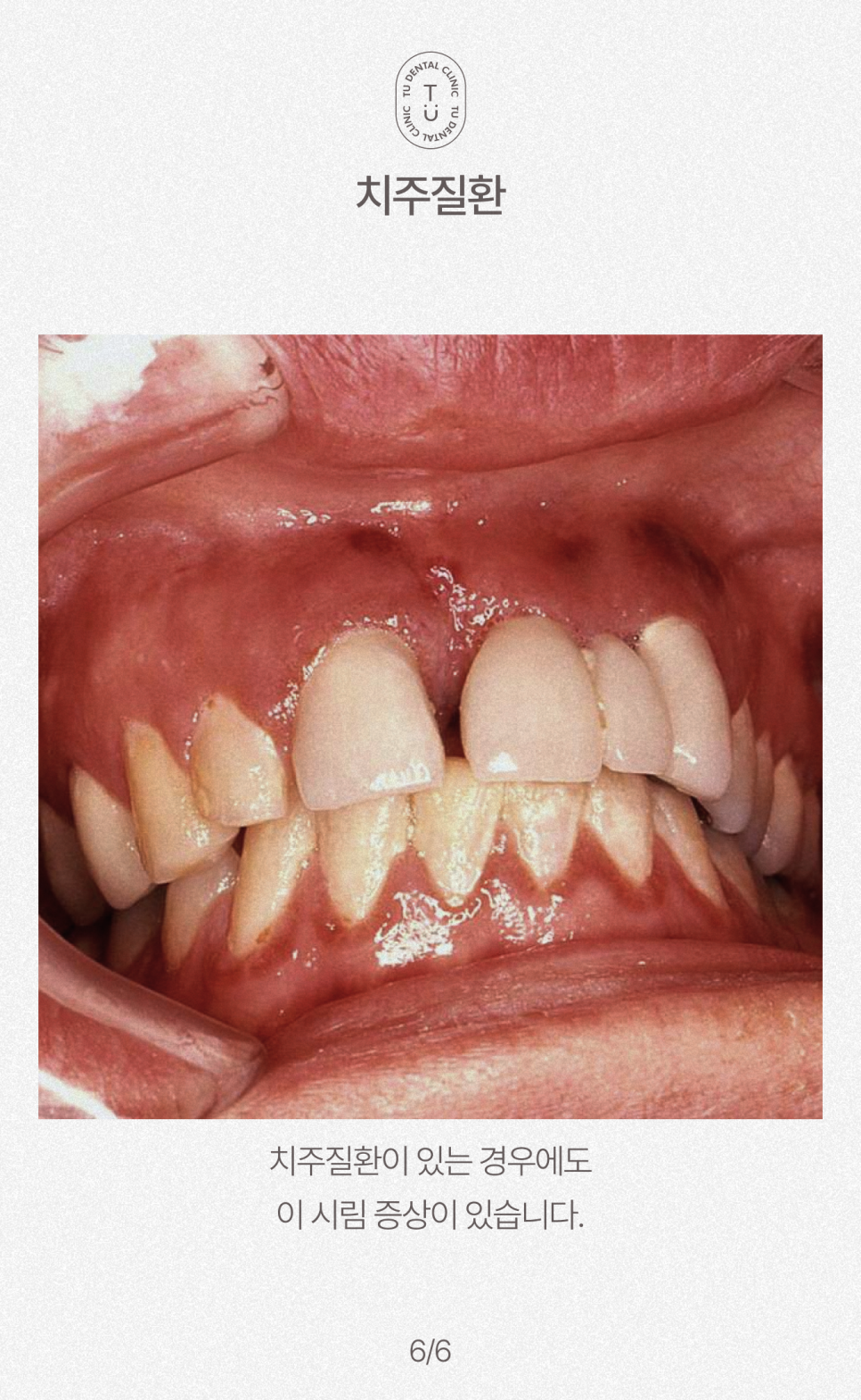 여름철, 이 시린이유가 뭘까요? 티유치과[TU치과] 관련 이미지 7