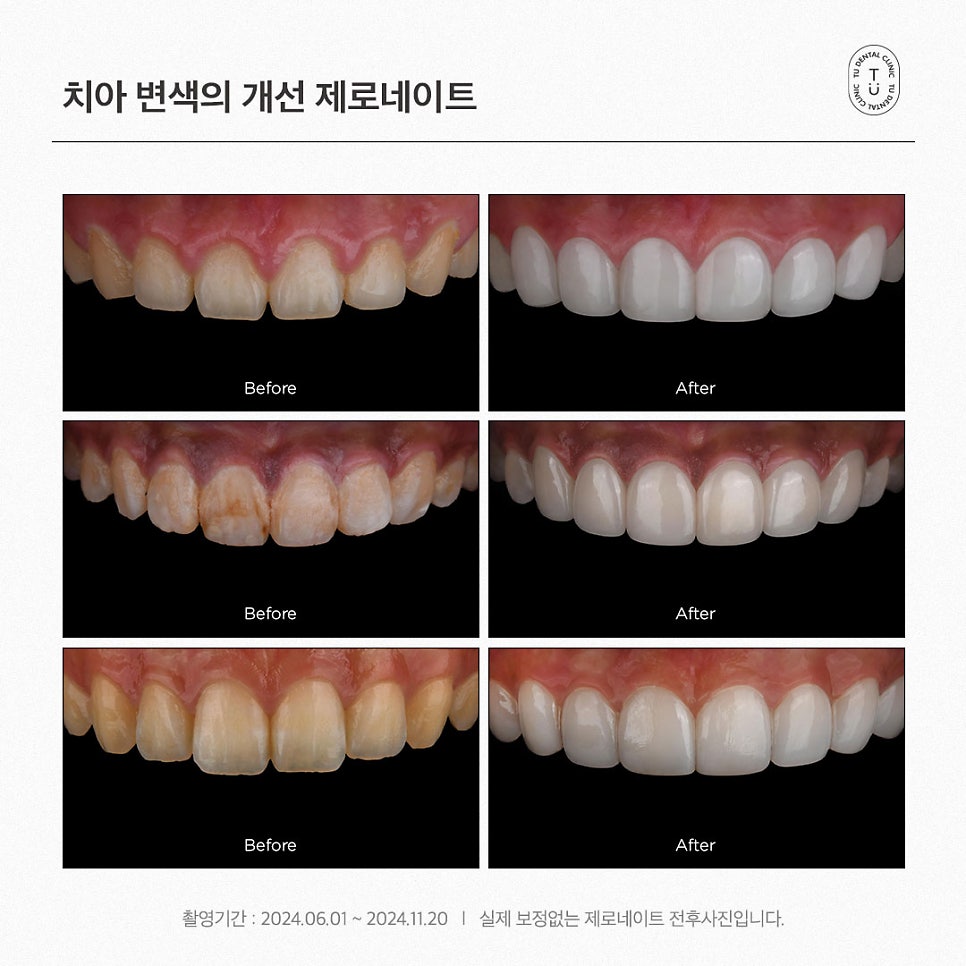 [티유치과] 치아미백으로 해결되지 않는 변색 치아의 치료법, 제로네이트 관련 이미지 6