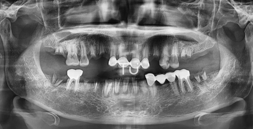 TU 임플란트 치료사례 : 구치부, 브릿지 관련 이미지 2