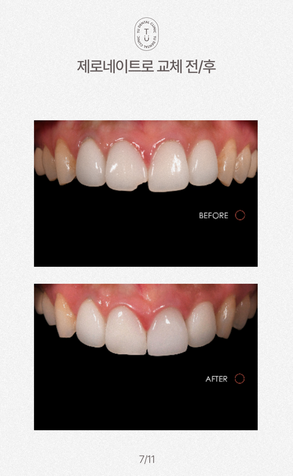 오래된 라미네이트 교체하셔야 됩니다, 티유치과[TU치과] 관련 이미지 8