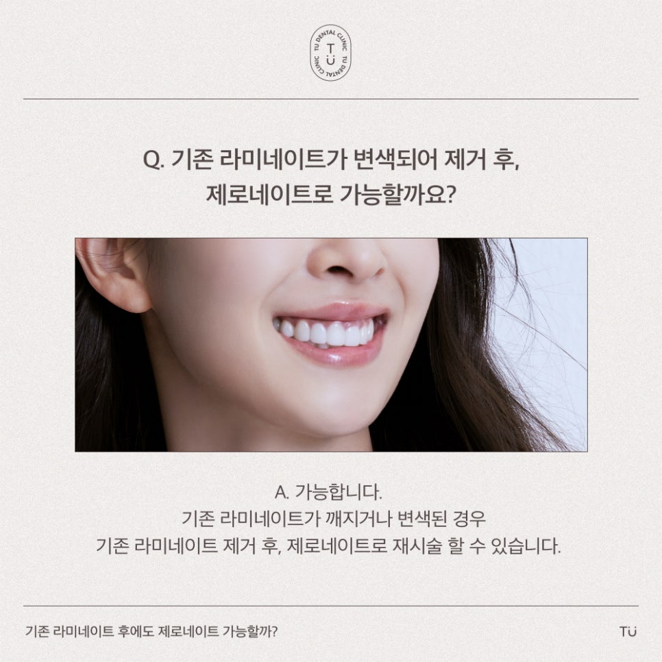 [티유치과] 기존 라미네이트를 제로네이트로 교체도 가능할까요?[TU치과] 관련 이미지 3
