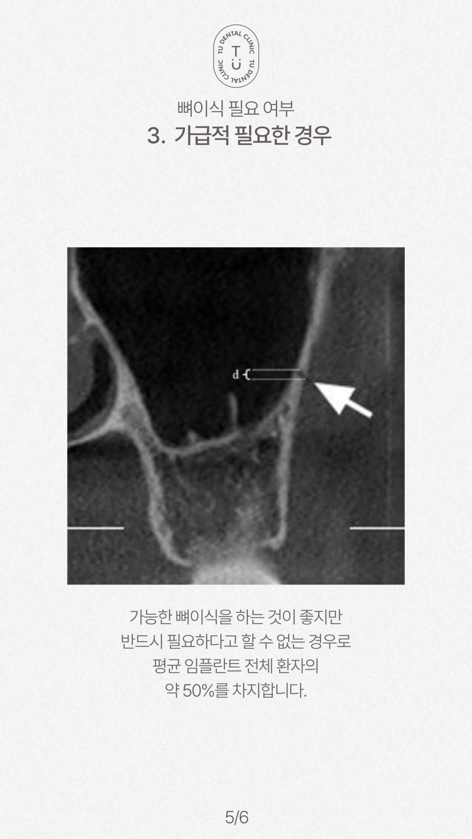 임플란트 뼈이식 꼭 해야할까요? 티유치과[TU치과] 관련 이미지 6