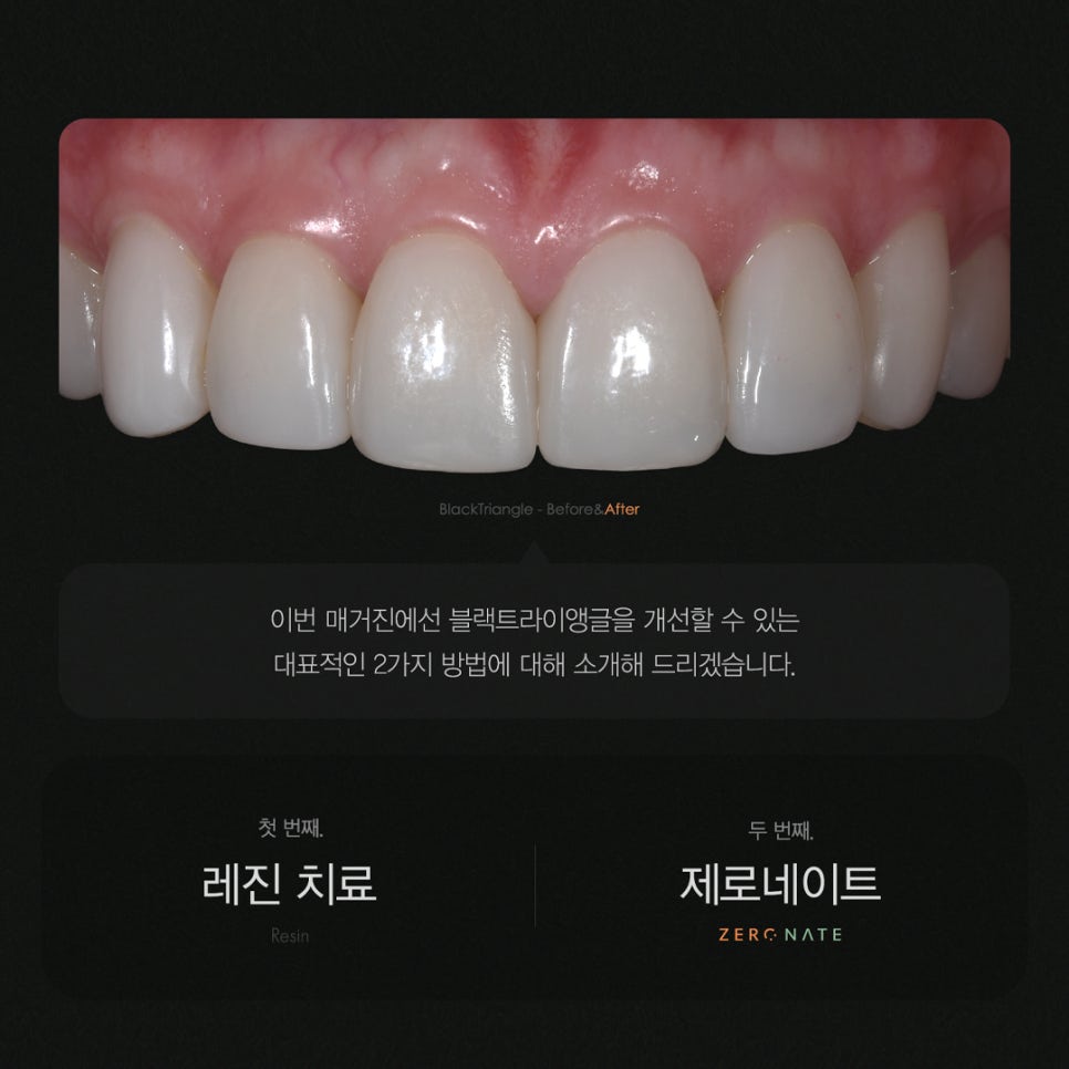 티유치과 4월 매거진, 블랙트라이앵글 치아의 치료법 [TU치과] 관련 이미지 3