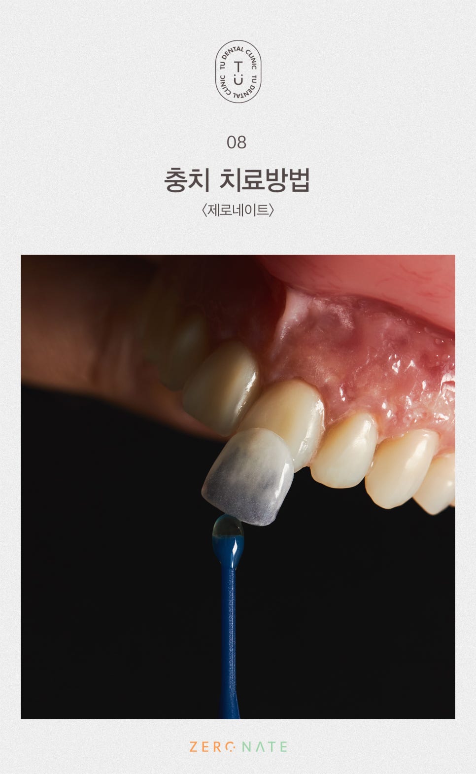 충치의 개선 제로네이트[TU치과] 관련 이미지 9