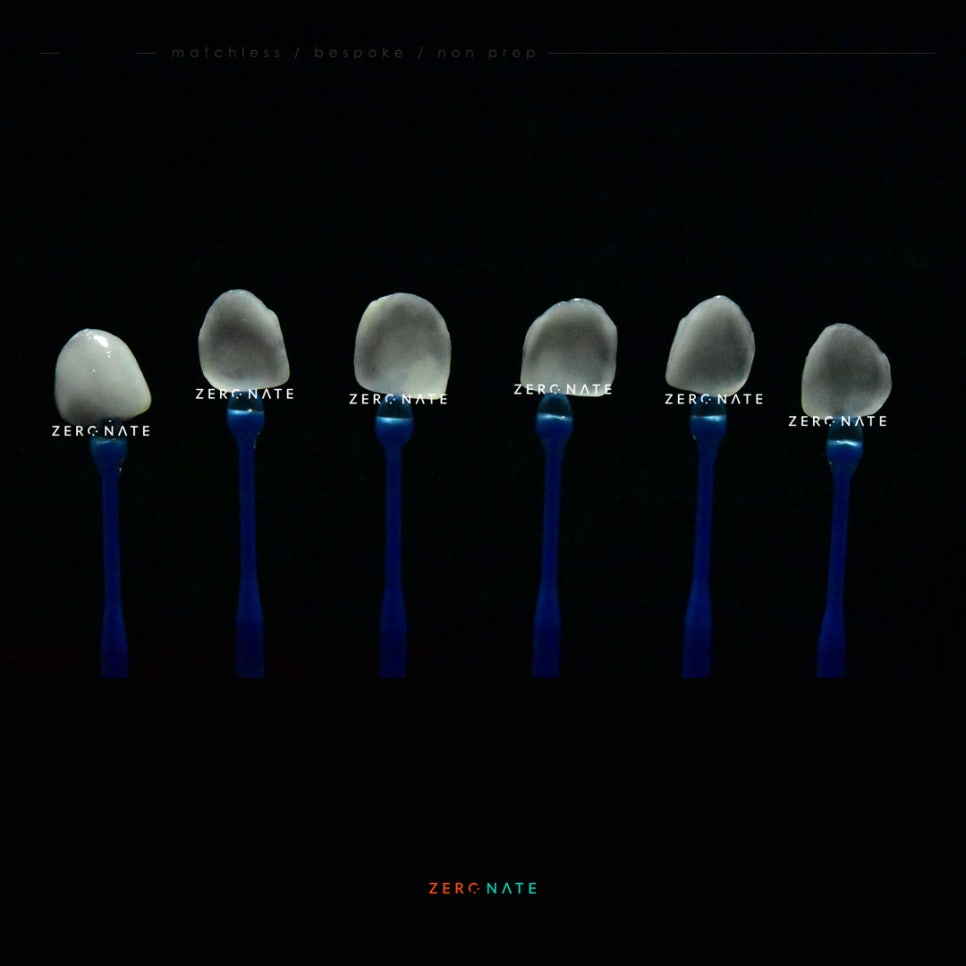깨진 앞니 치료 제로네이트 사례 : 티유치과 관련 이미지 5