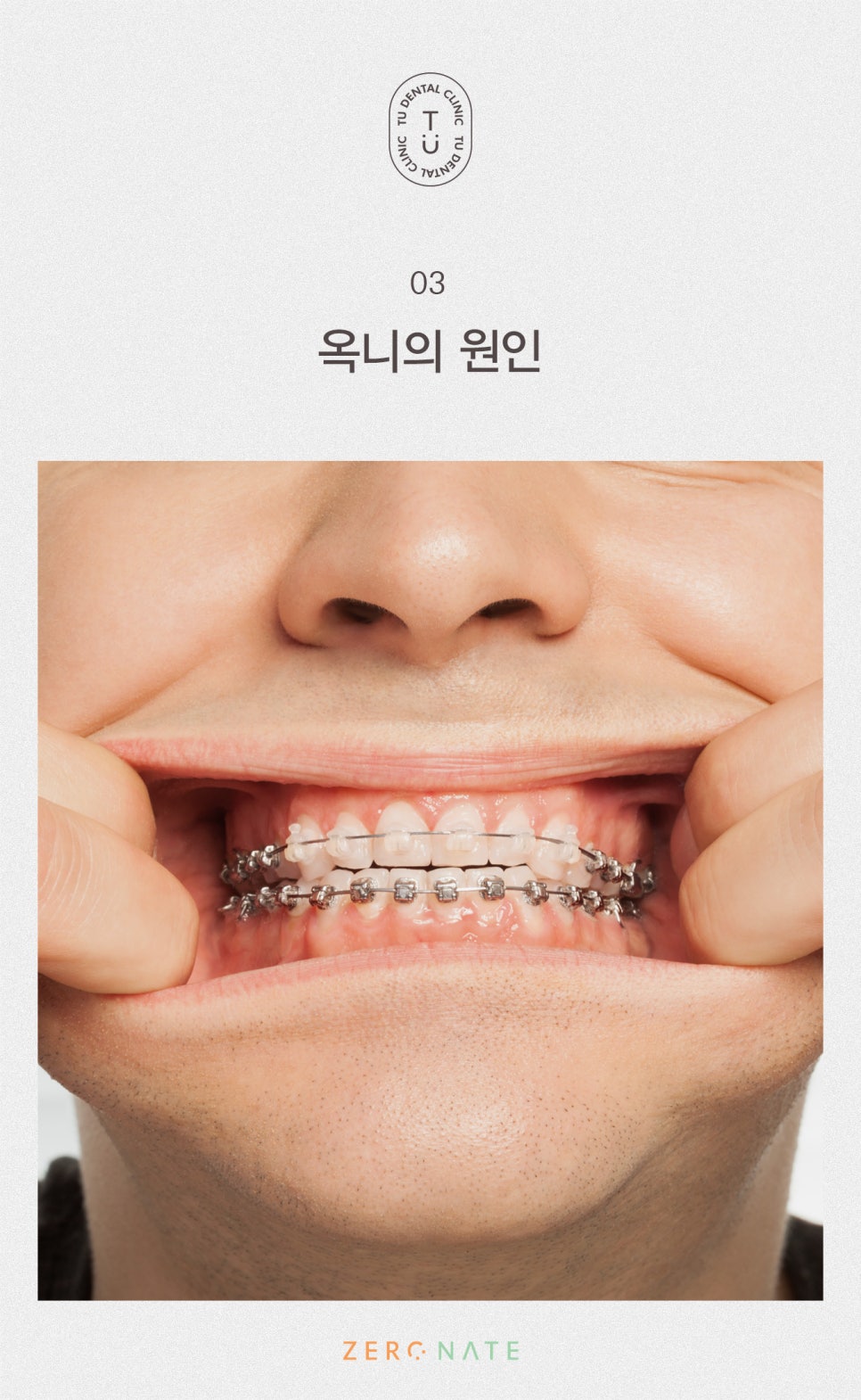 티유치과 옥니 치료법, 옥니에도 제로네이트 [TU치과] 관련 이미지 4