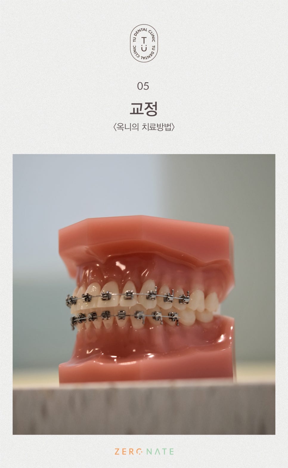 티유치과 옥니 치료법, 옥니에도 제로네이트 [TU치과] 관련 이미지 6