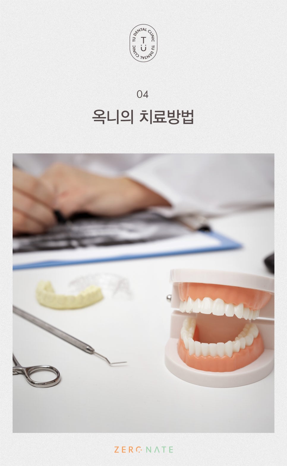 티유치과 옥니 치료법, 옥니에도 제로네이트 [TU치과] 관련 이미지 5