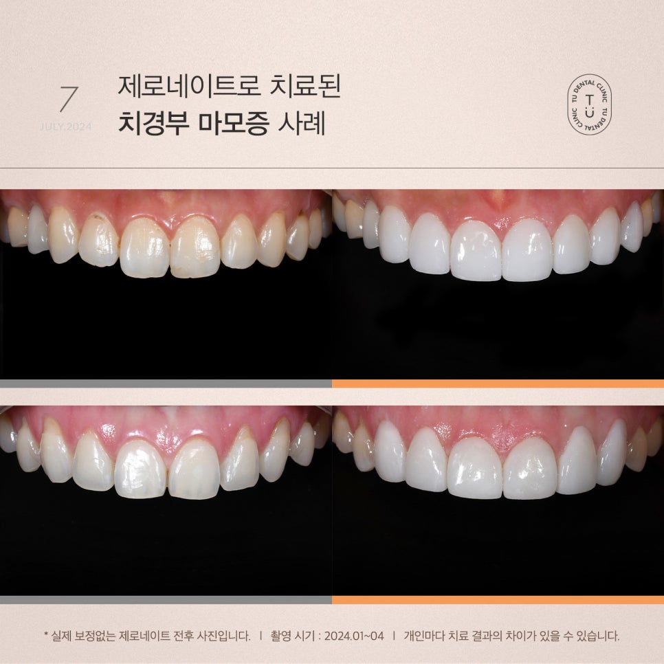 티유치과 7월 매거진, 치경부 마모증 치료법 [TU치과] 관련 이미지 8