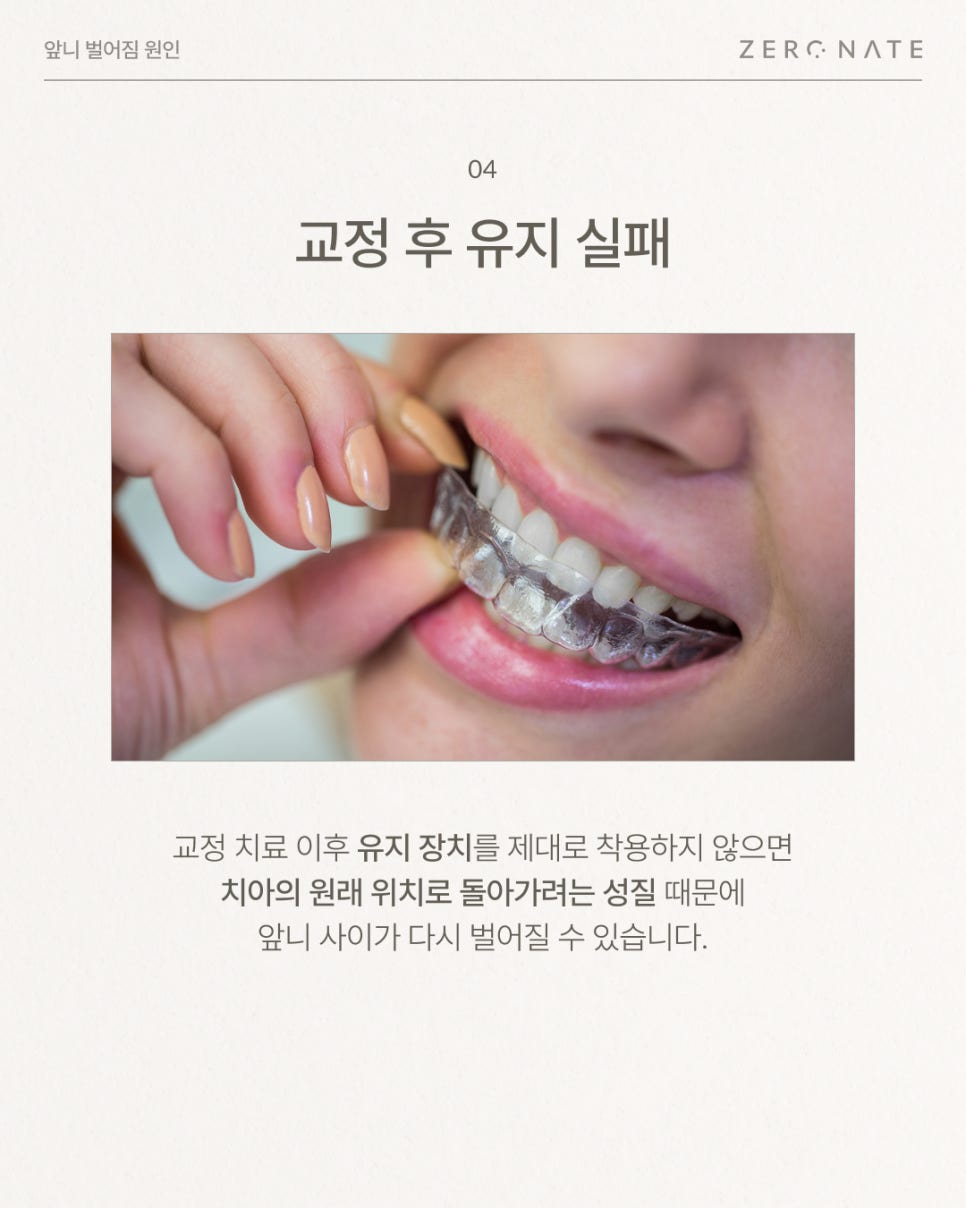 앞니벌어짐 원인부터 치료 방법 총정리 (레진, 라미네이트, 교정) 관련 이미지 5