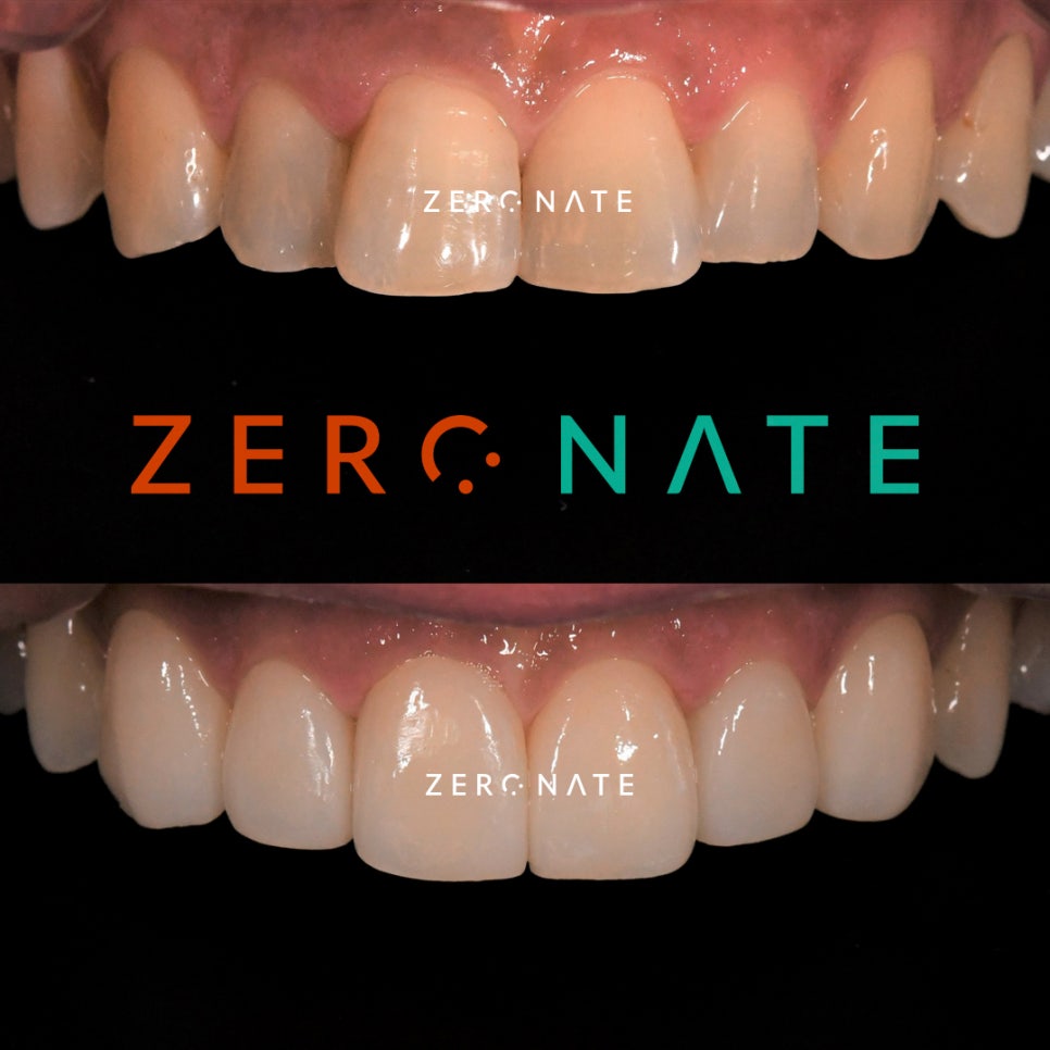 제로네이트 : 치아길이의 개선 사례 관련 이미지 5