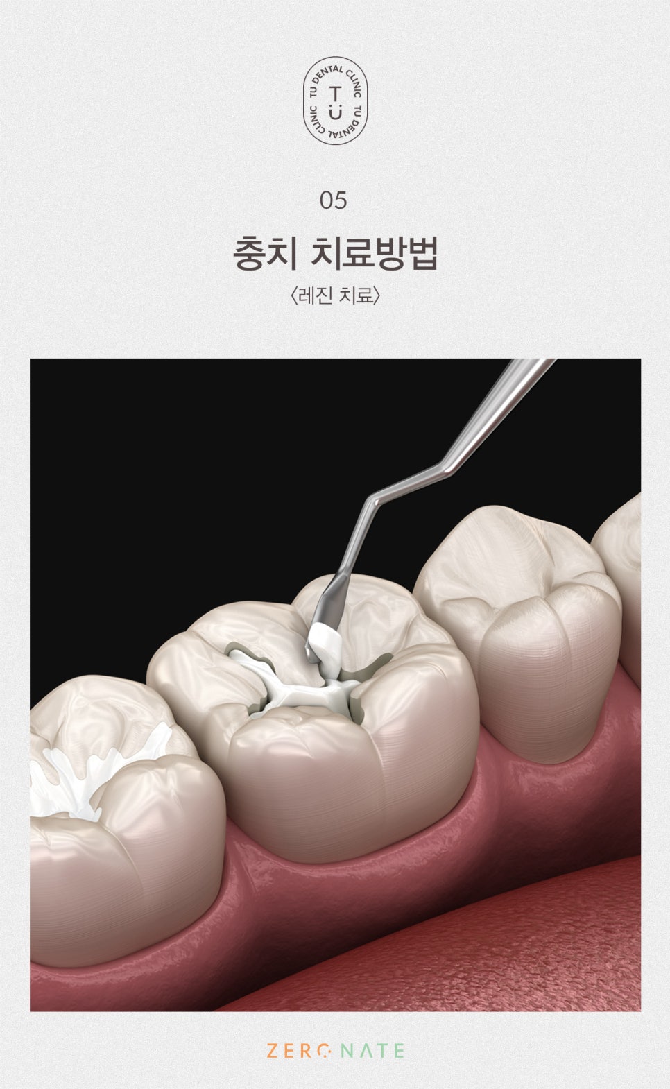 충치의 개선 제로네이트[TU치과] 관련 이미지 6