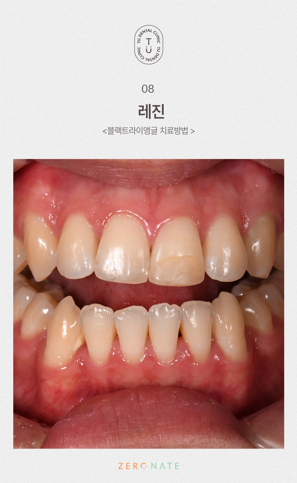 티유치과 블랙트라이앵글 제로네이트 [TU치과] 관련 이미지 9