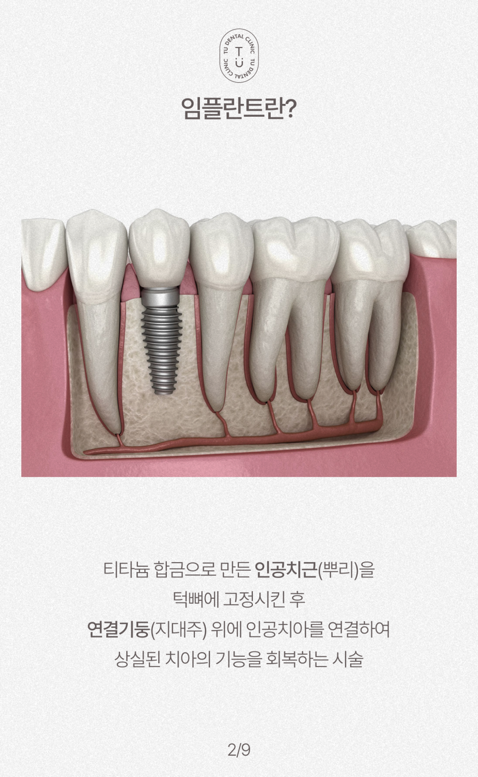 임플란트 보험 비용 알려드립니다, 건강보험 가능한 티유치과 [TU치과] 관련 이미지 3