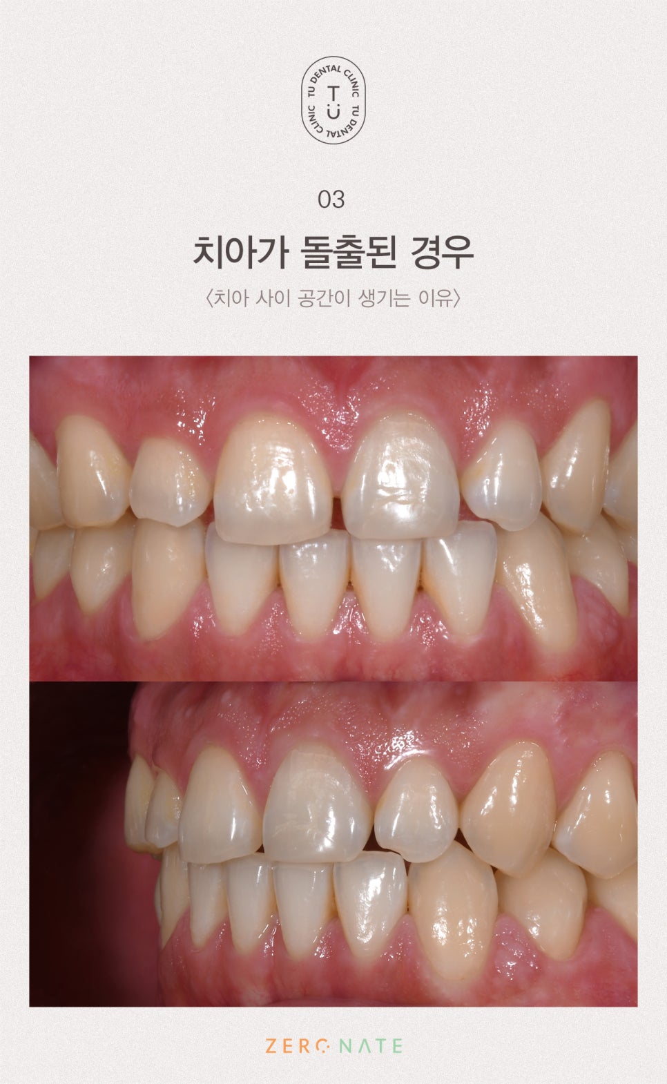 치아 사이 공간 치료방법, 티유치과[TU치과] 관련 이미지 4