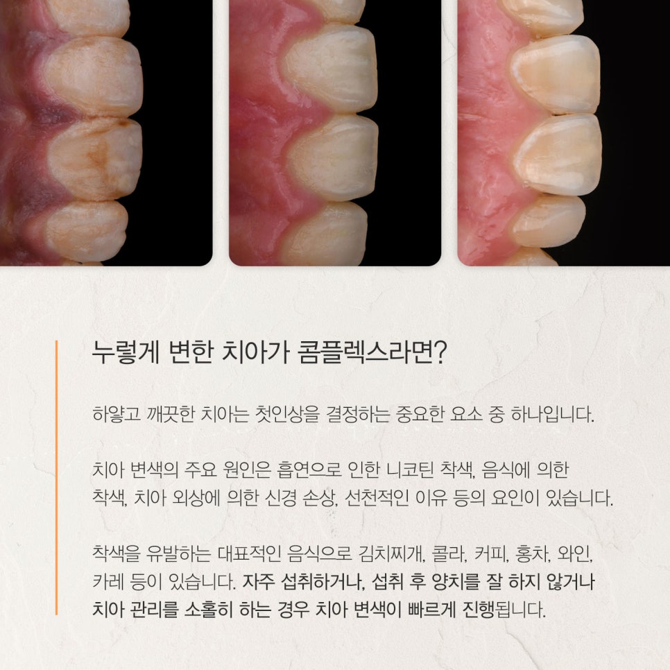 티유치과 6월 매거진, 변색된 치아의 치료법 [TU치과] 관련 이미지 2