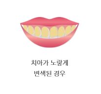 [TU치과/티유치과] 치아변색?? 치아미백으로 해결! 관련 이미지 3