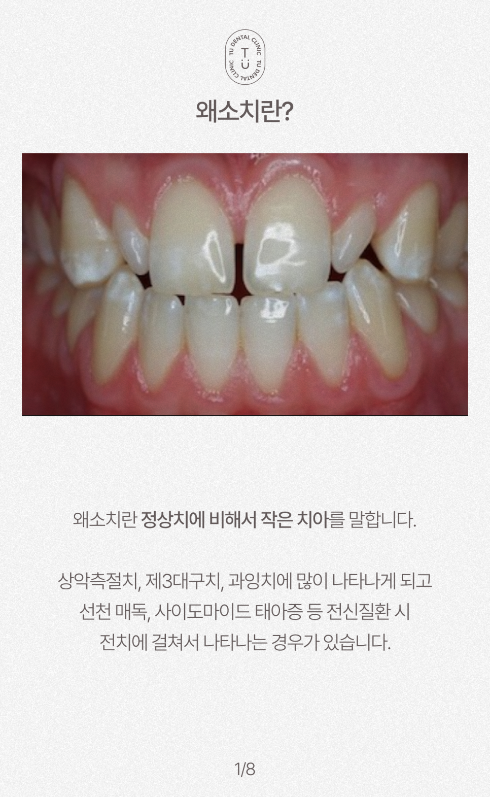 왜소치 치료방법, 작은치아 라미네이트, 제로네이트 알려드립니다! 티유치과[TU치과] 관련 이미지 2