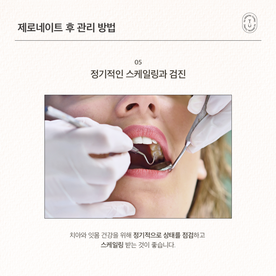 라미네이트 수명 오래가게 하려면? 제로네이트 후 치아 건강 이렇게 지키세요. 관련 이미지 6