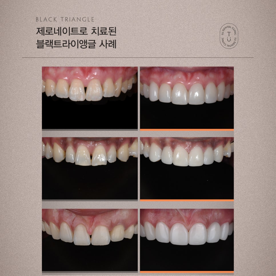 티유치과 4월 매거진, 블랙트라이앵글 치아의 치료법 [TU치과] 관련 이미지 7