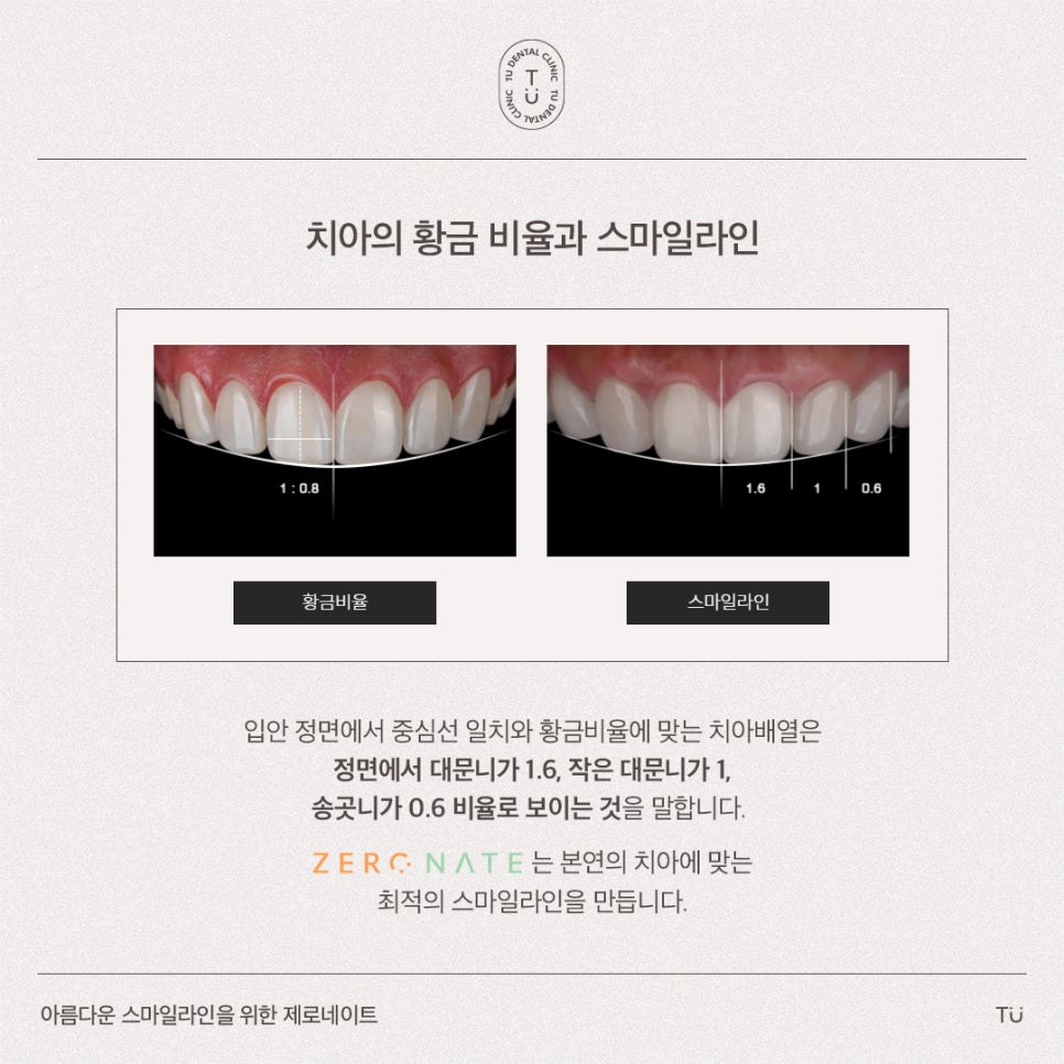 [티유치과] 아름다운 스마일라인을 위한 제로네이트 관련 이미지 4