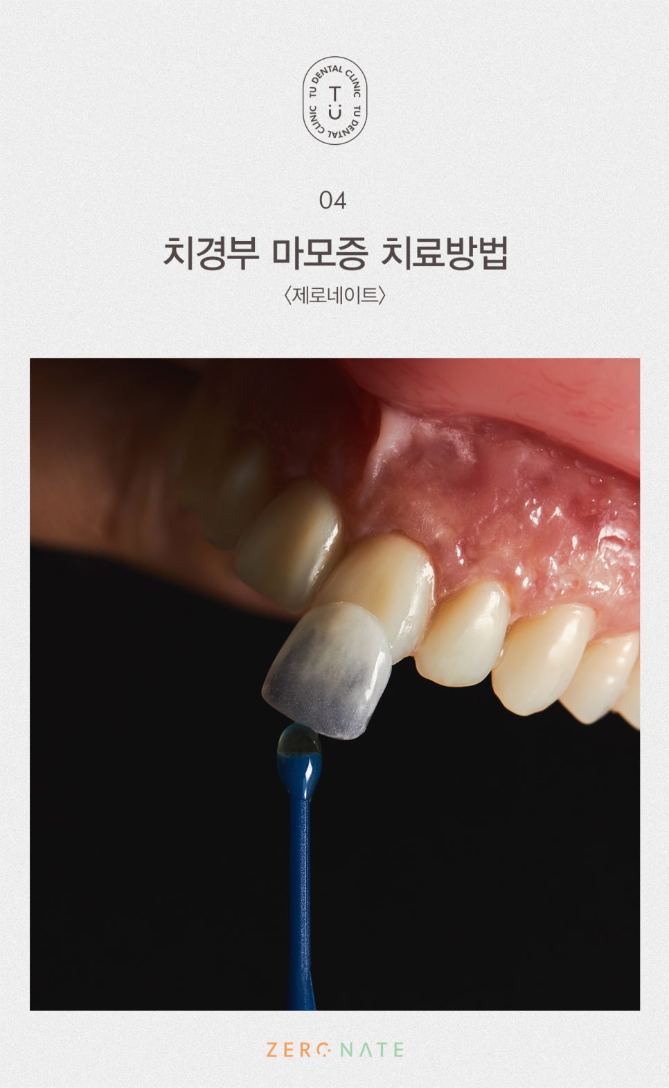 치경부 마모증 치료방법, 티유치과 제로네이트[TU치과] 관련 이미지 9
