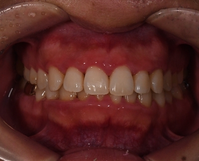 [TU치과/티유치과] 치아변색?? 치아미백으로 해결! 관련 이미지 8