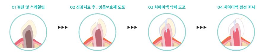 [TU치과/티유치과] 치아변색?? 치아미백으로 해결! 관련 이미지 4