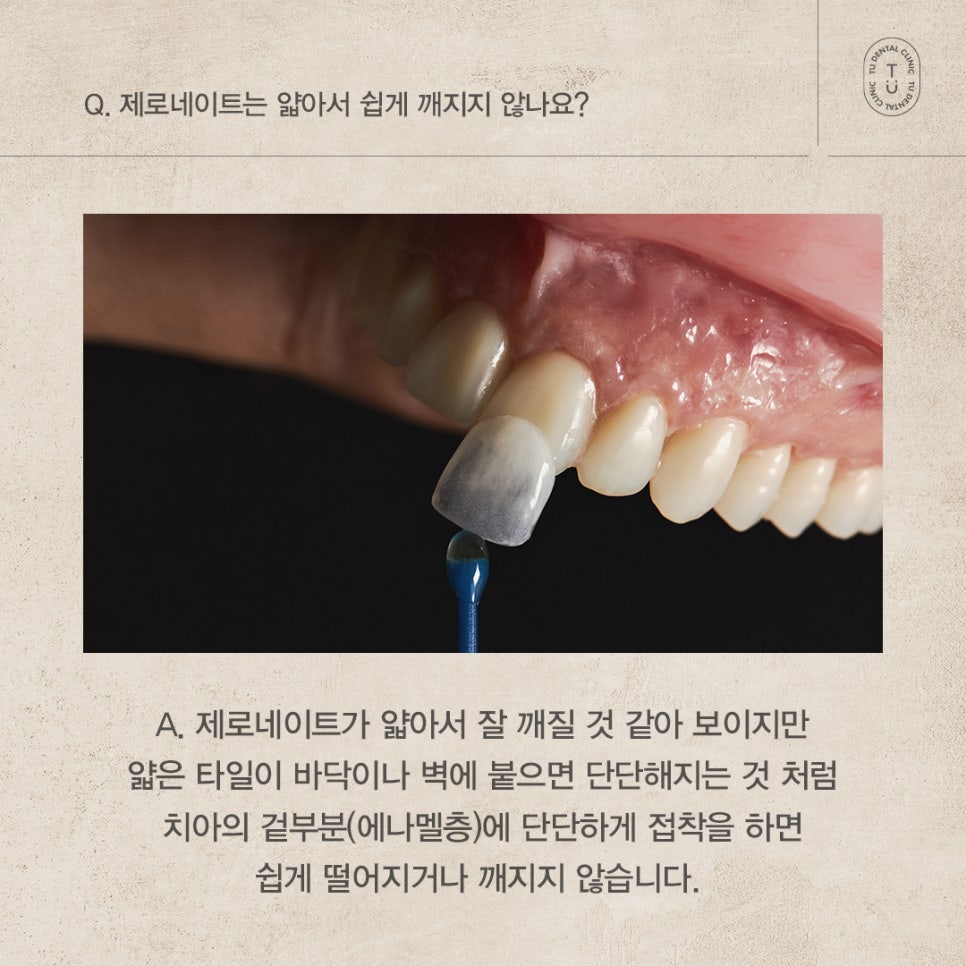 제로네이트 자주 묻는 질문 FAQ ｜ PART.2[TU치과] 관련 이미지 3