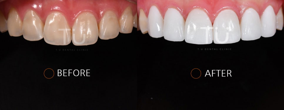 누렇게 변색된 치아의 개선 case : 제로네이트 관련 이미지 4