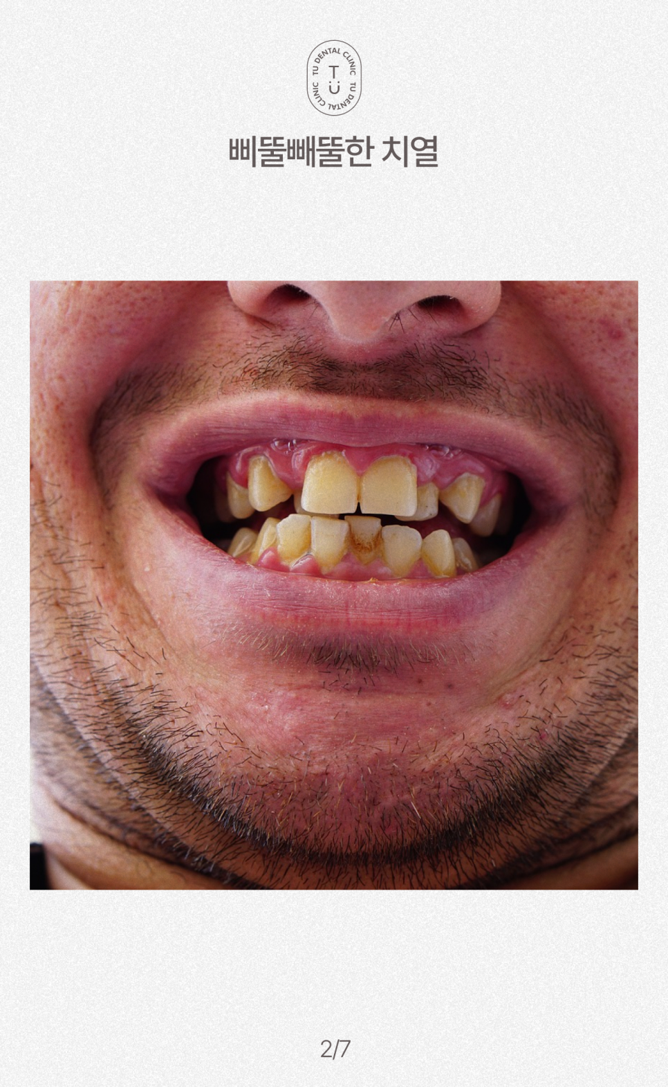 철도의 날, 삐뚤빼뚤한 치아에 철도공사하세요! 티유치과[TU치과] 관련 이미지 3