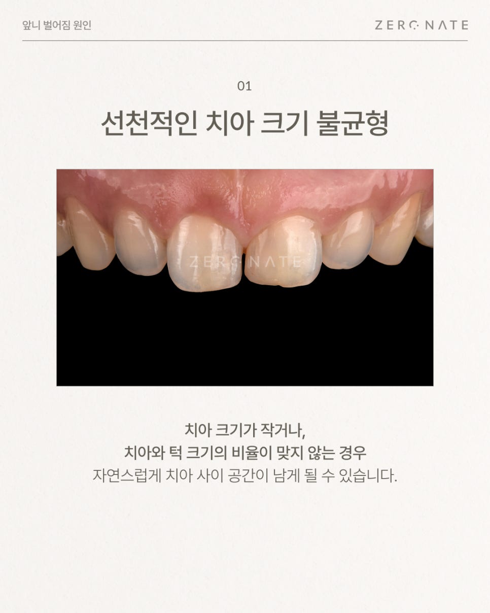앞니벌어짐 원인부터 치료 방법 총정리 (레진, 라미네이트, 교정) 관련 이미지 2