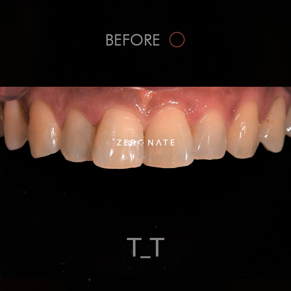 제로네이트 : 치아길이의 개선 사례 관련 이미지 3