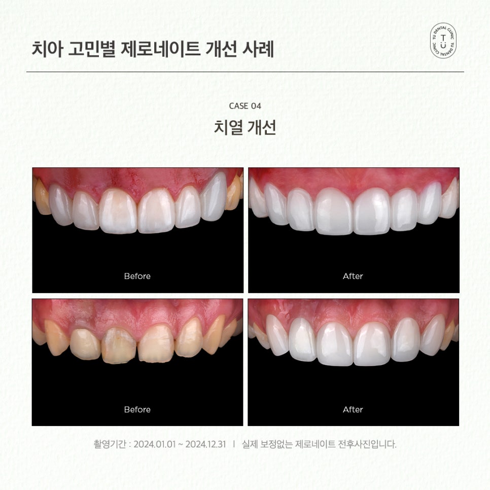 치아 고민별 제로네이트 개선 사례 (유형별 라미네이트 전후) 관련 이미지 7