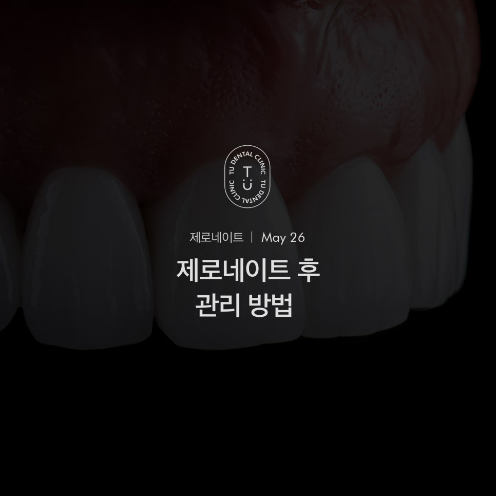 라미네이트 수명 오래가게 하려면? 제로네이트 후 치아 건강 이렇게 지키세요. 관련 이미지 1