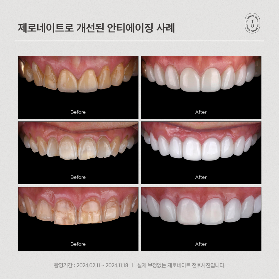 [티유치과] 안티에이징의 치료법, 제로네이트[TU치과] 관련 이미지 8