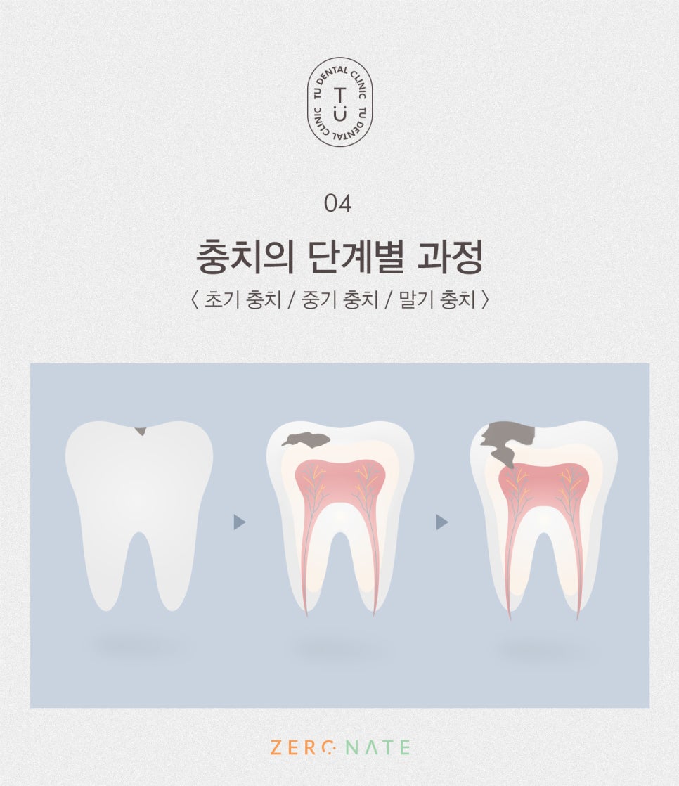 충치의 개선 제로네이트[TU치과] 관련 이미지 5