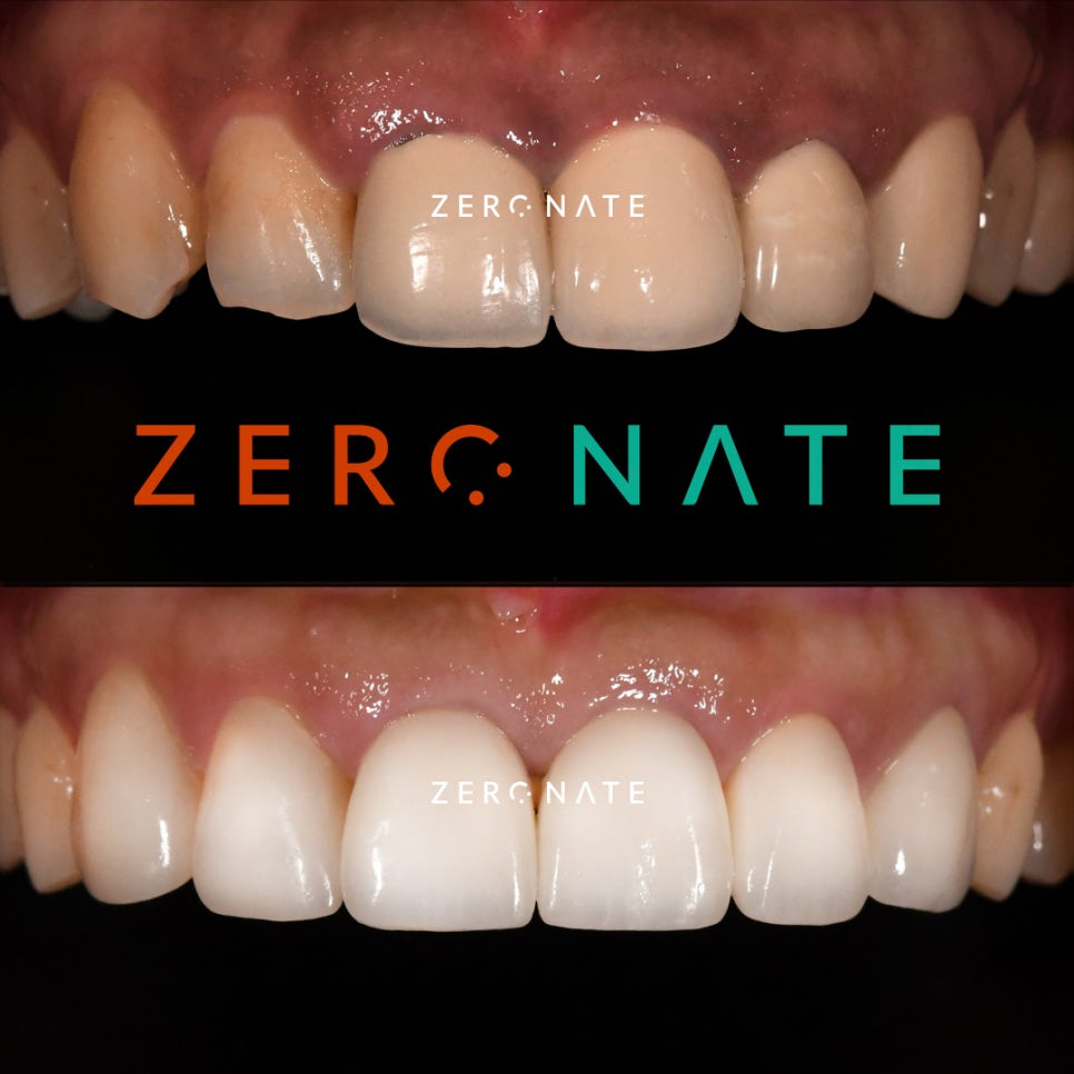 TU치과 제로네이트 사례 : 치아모양 개선 관련 이미지 4