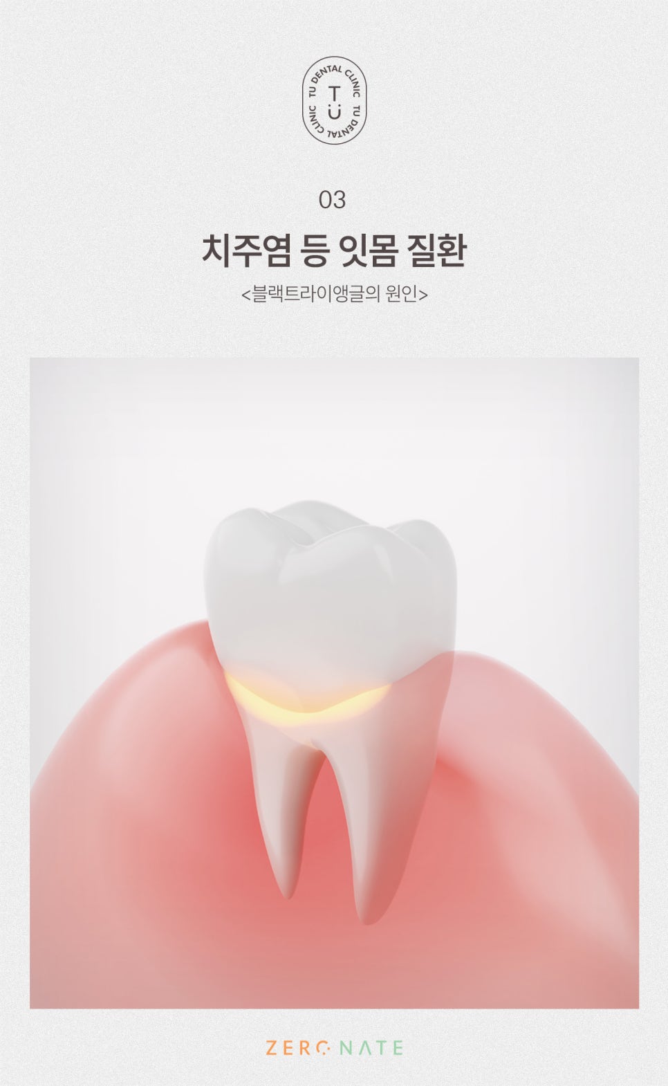 티유치과 블랙트라이앵글 제로네이트 [TU치과] 관련 이미지 4