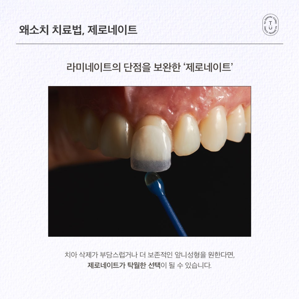 왜소치 라미네이트 제로네이트 자연스러운 미소를 되찾는 앞니성형 관련 이미지 5