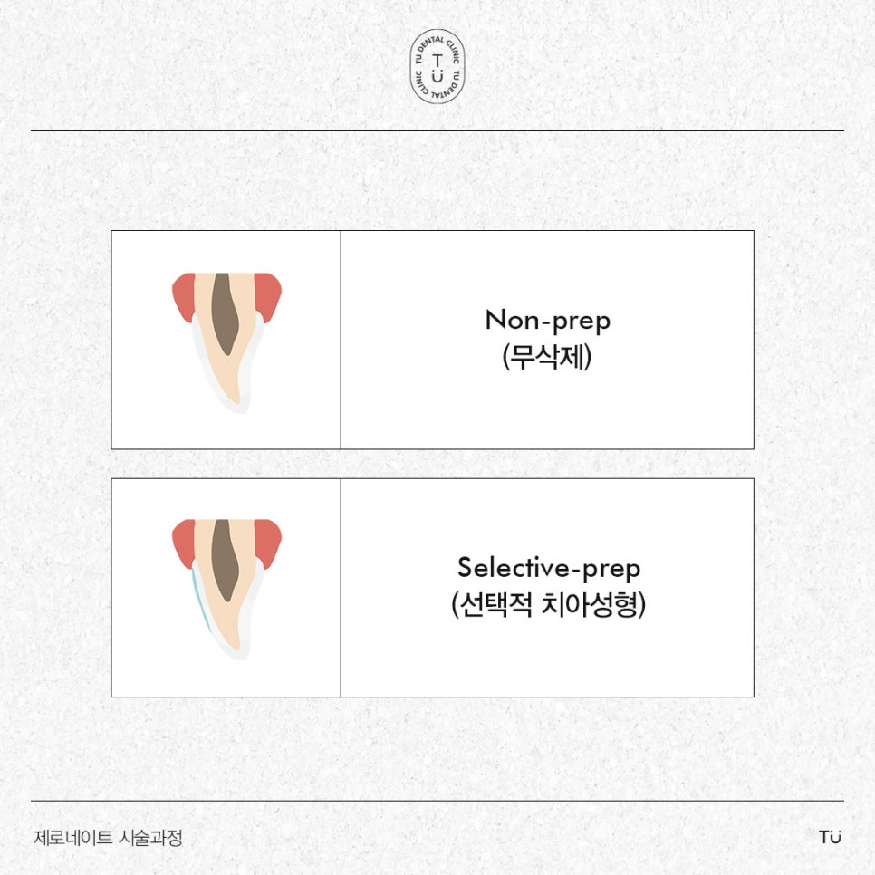 티유치과 제로네이트 시술과정 [TU치과] 관련 이미지 3