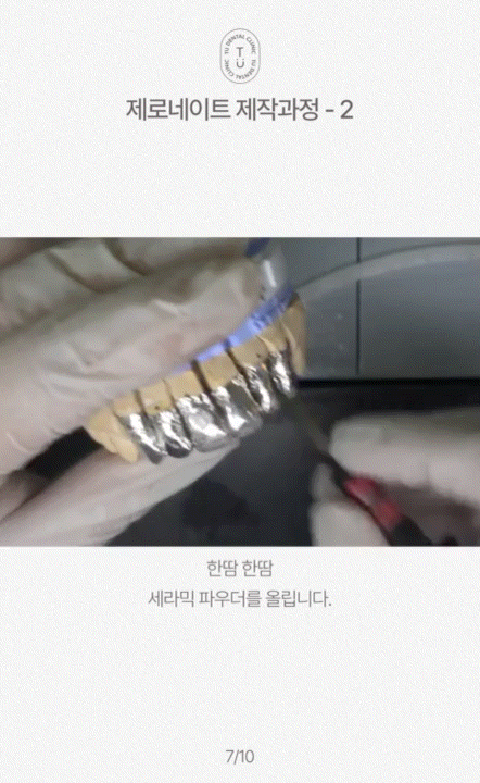 제로네이트 제작 과정 알려드립니다, 티유치과[TU치과] 관련 이미지 8