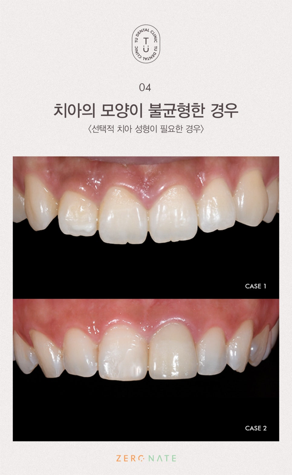 티유치과 선택적 치아 성형 [TU치과] 관련 이미지 5