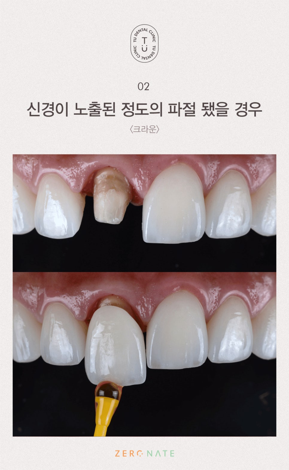 파절된 치아 치료방법, 티유치과[TU치과] 관련 이미지 3